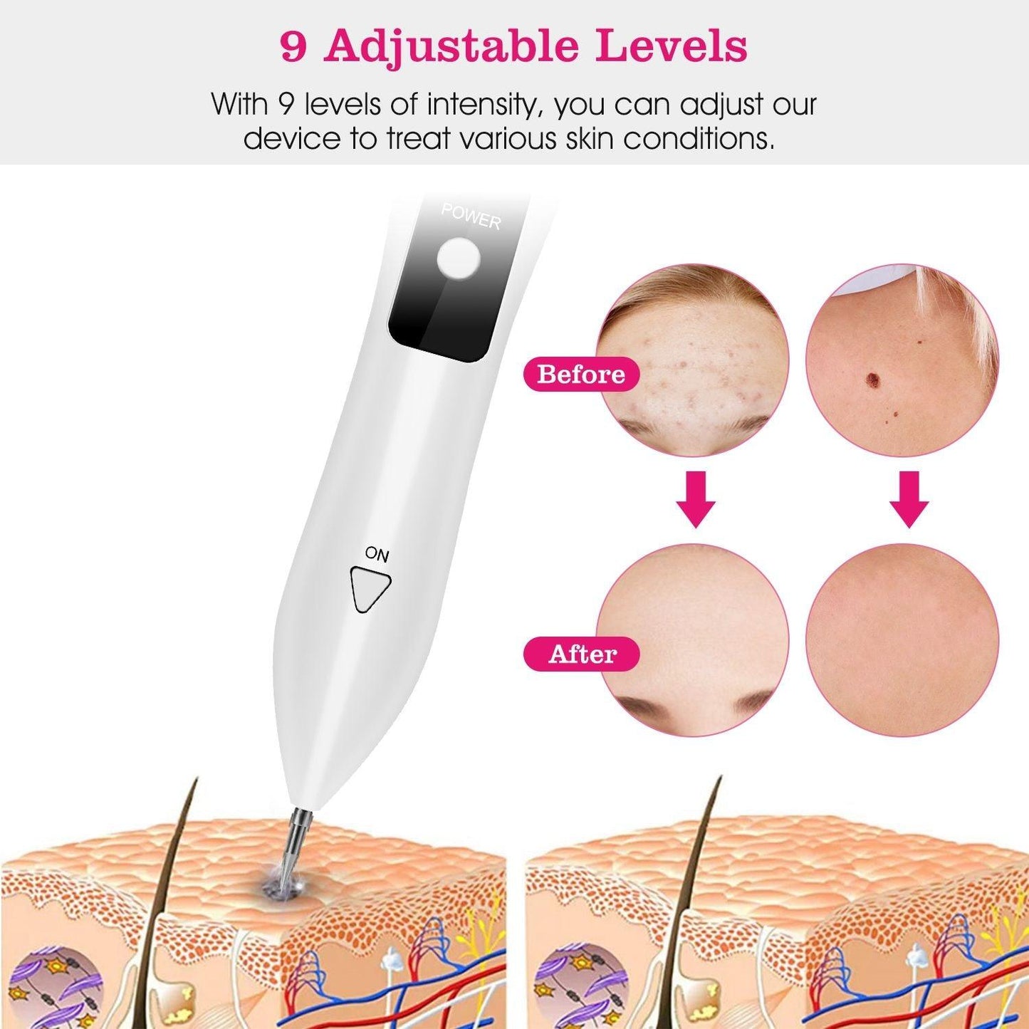 Skin Tag Repair Kit Portable Beauty Equipment Multi-Level with Home Usage USB Charging LCD Level Adjustable 6 Replaceable Needles - Clothes For Her Online Store